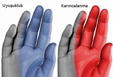 El Uyuşması | El Uyuşması Nedenleri 1 el uyusmasi